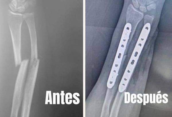 Fracturas